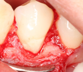 External cervical resorption - Post-op case 2